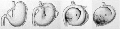 Stadia van de maagkanteling.